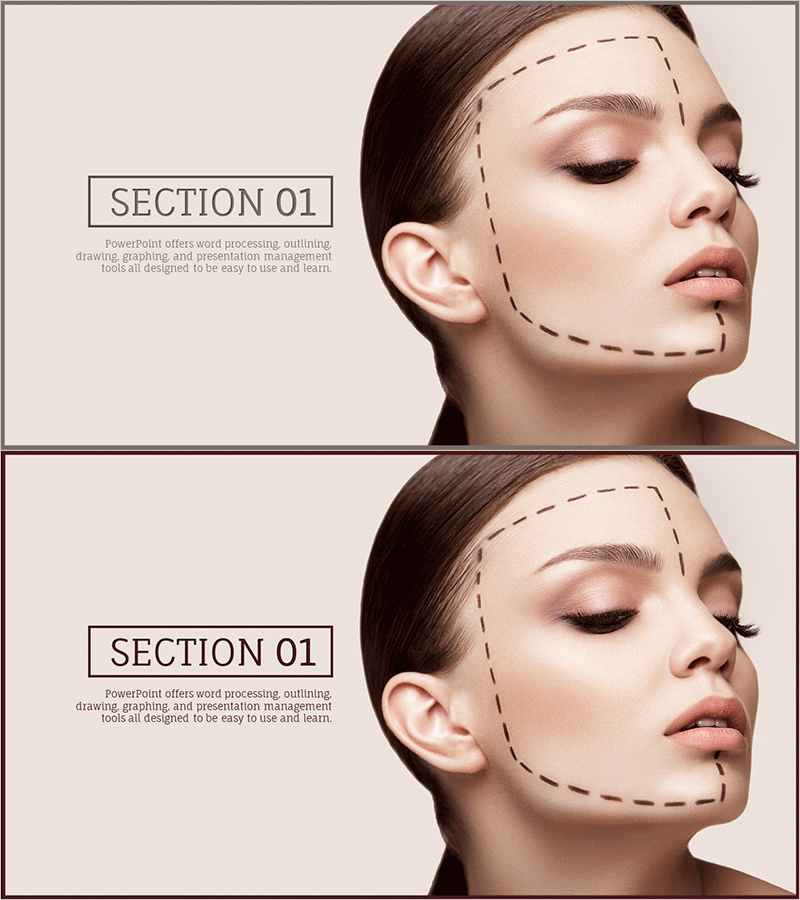 성형수술 간지 슬라이드 – 완벽한 아름다움의 추구